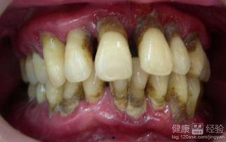 洗牙多久可以吃瓜,洗牙后多久可享美味瓜果？健康饮食时间指南